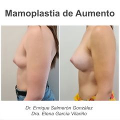 Aumento de pecho - Dr. Enrique Salmeron