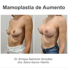 Aumento de pecho - Dr. Enrique Salmeron