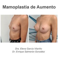 Aumento de pecho - Dr. Enrique Salmeron
