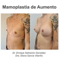 Aumento de pecho - Dr. Enrique Salmeron