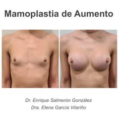 Aumento de pecho - Dr. Enrique Salmeron