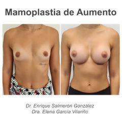 Aumento de pecho - Dr. Enrique Salmeron