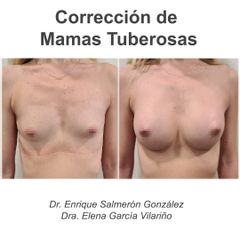 Aumento de pecho - Dr. Enrique Salmeron