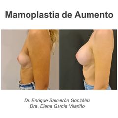 Aumento de pecho - Dr. Enrique Salmeron