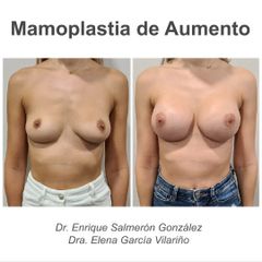Aumento de pecho - Dr. Enrique Salmeron
