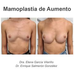 Aumento de pecho - Dr. Enrique Salmeron