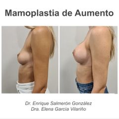 Aumento de pecho - Dr. Enrique Salmeron