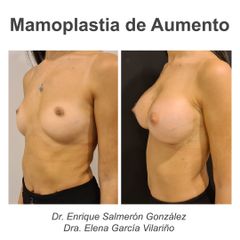 Aumento de pecho - Dr. Enrique Salmeron