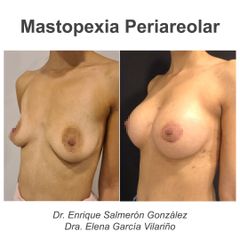 Mastopexia - Dr. Enrique Salmeron