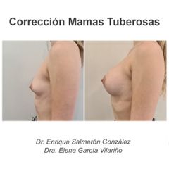 Mamas tuberosas - Dr. Enrique Salmeron