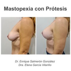 Mastopexia - Dr. Enrique Salmeron