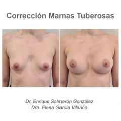 Mamas tuberosas - Dr. Enrique Salmeron