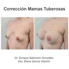 Mamas tuberosas - Dr. Enrique Salmeron