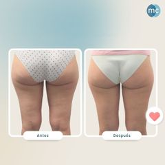 Celulitis - Medcare Health & Beauty