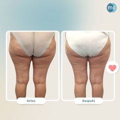 Celulitis - Medcare Health & Beauty