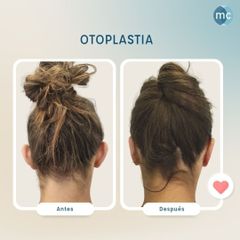Otoplastia - Medcare Health & Beauty