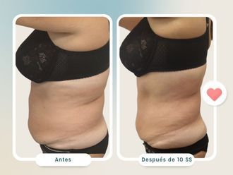 Presoterapia antes y después - 820802