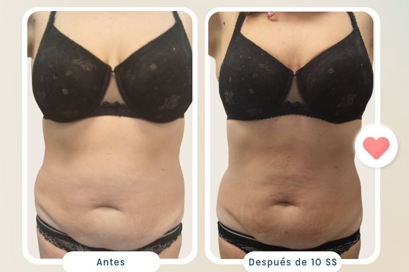 Presoterapia antes y después - 820804