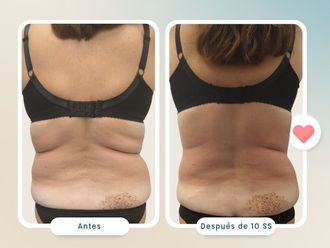 Presoterapia antes y después - 820806
