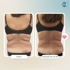 Tratamieinto corporal reductor - Medcare Health & Beauty