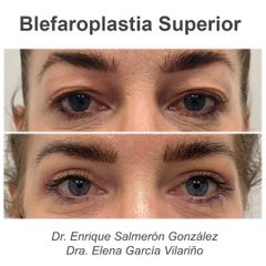 Blefaroplastia - Medcare Health & Beauty