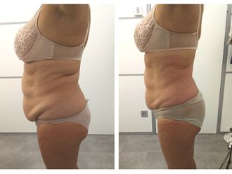 Tratamiento obesidad antes y después - 857448