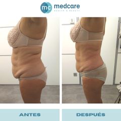 Tratamiento obesidad - Medcare Health & Beauty