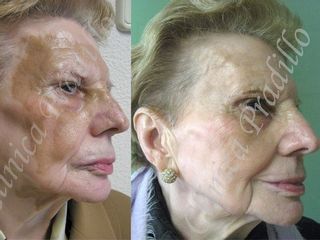 Antes y después vitiligo (Laser)