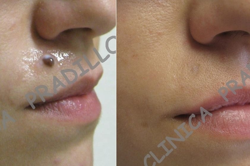 Angiomas antes y después - 557044
