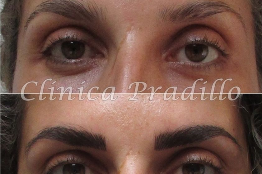 Micropigmentación antes y después - 557440