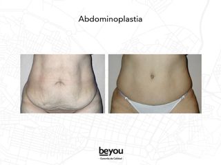 Abdominoplastia