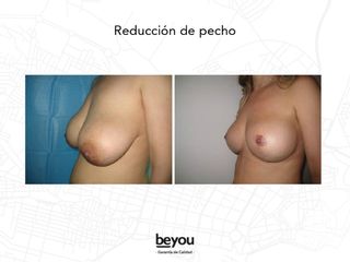 Reducción de Pecho