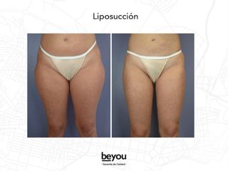 Liposucción