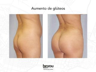 Gluteoplastia