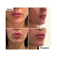 Aumento de labios - Be You Clínica