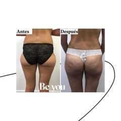 Liposucción - Be You Clínica