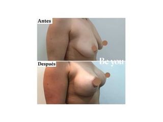 Aumento pecho mamas tuberosas BeYou