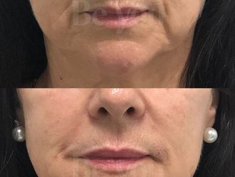 Rejuvenecimiento facial antes y después - 866774