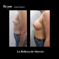 Aumento de pecho perfil - Clínica Be you