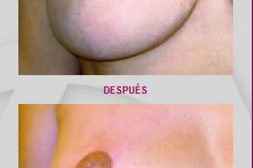 Micropigmentación antes y después - 373810