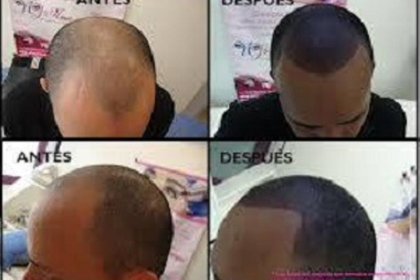 Alopecia antes y después - 418901