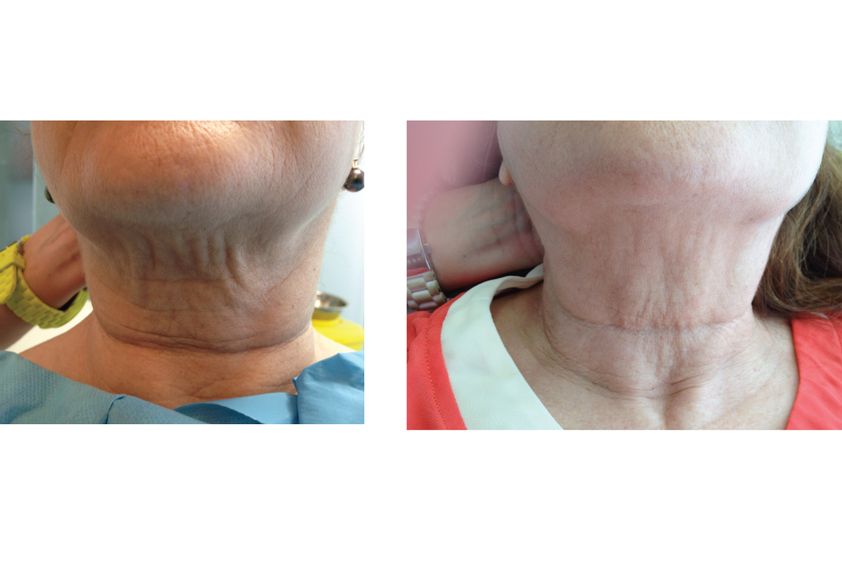 Carboxiterapia antes y después - 379989