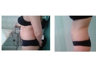 Reducción abdomen