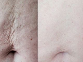 Tensar abdomen