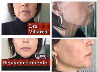 Rejuvenecimiento facial 