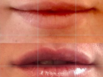 Aumento labios - 631997
