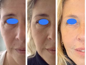 Rejuvenecimiento facial - 647315