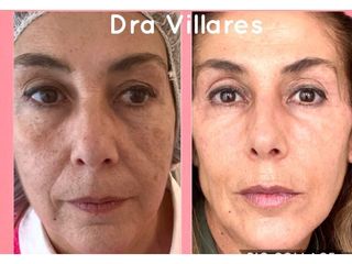 Eliminación de ojeras - Doctora Villares