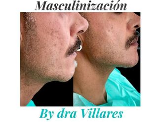 Rellenos faciales - 701398