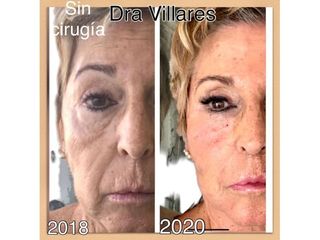 Ácido hialurónico - Doctora Villares